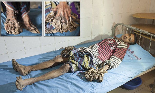 ঢাকা মেডিকেলে বৃক্ষমানব আবুলের দুটি আঙুলে সফল অস্ত্রোপচার সম্পন্ন ।।