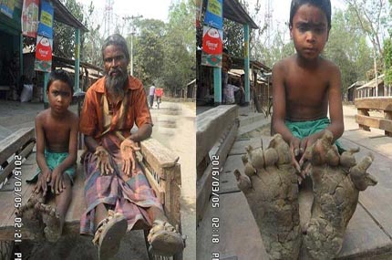 প্রধানমন্ত্রীর এপিএসের নির্দেশে রংপুরের বৃক্ষমানব বাবা ও ছেলে এখন ঢামেক হাসপাতালে ।।