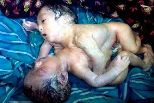 পাইকগাছায় জোড়া লাগানো দুই শিশুর জন্মের আড়াই ঘন্টা পর চিকিৎসাধীন অবস্থায় মৃত্যু