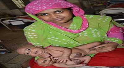 সফল অস্ত্রোপচারের মাধ্যমে পৃথক হলো জোড়া শিশু