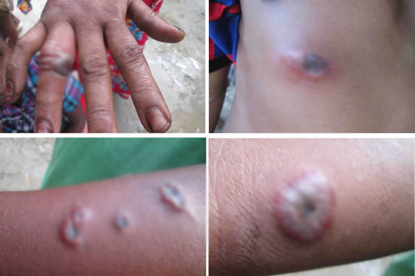 সাস্থ্যমন্ত্রীর জেলা সিরাজগঞ্জে ফের অ্যানথ্রাক্স রোগে আক্রন্ত মানুষ ।। গতকালই সাস্থ্য বিভাগ সনাক্ত করেছে ১৩ জনকে...