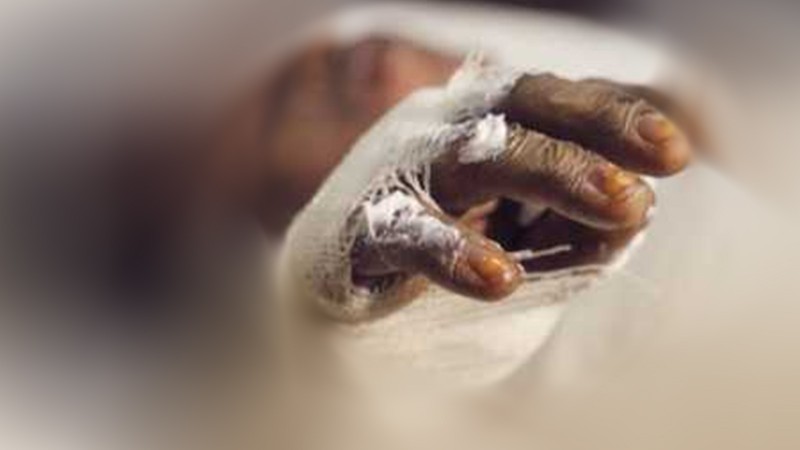 কোম্পানীগঞ্জে গ্যাস সিলিন্ডার বিস্ফোরণে ৩ শিশুসহ ৫ জন দগ্ধ ।।