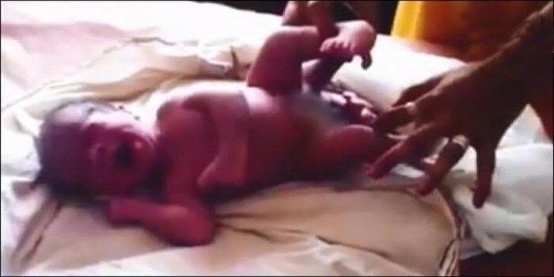 ভারতের উত্তরপ্রদেশে চার পা ও দুই জননাঙ্গ নিয়ে জন্ম নিলো শিশু