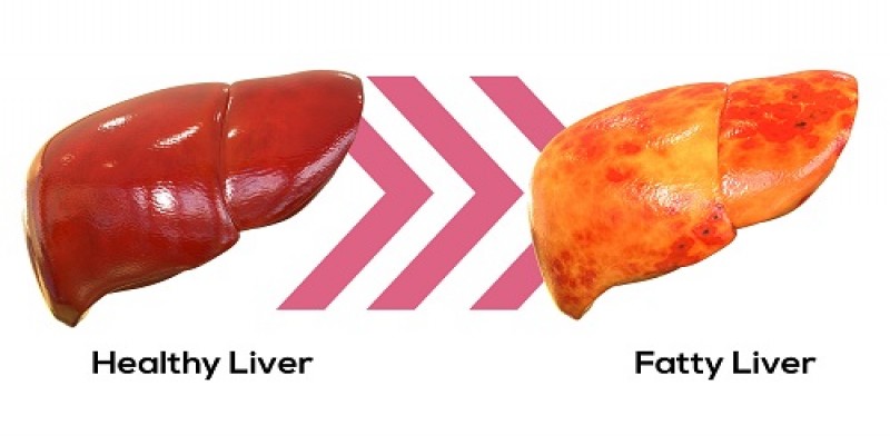 ওষুধ না খেয়েও ঘরোয়া চিকিৎসায় দূর করা যায় ফ্যাটি লিভারের সমস্যা   