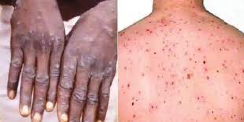 বিশ্বে দ্রুত ছড়িয়ে পড়া মাঙ্কিপক্সের চিকিৎসায় ভারতের তিনটি হাসপাতালকে দায়িত্ব॥