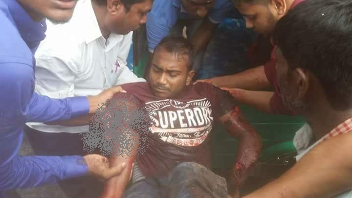 শিবির ক্যাডারদের হামলায় গুরুতর আহত ছাত্রলীগ কর্মী শাহীনের হাত কেটে বাদ দেয়া হল ।।