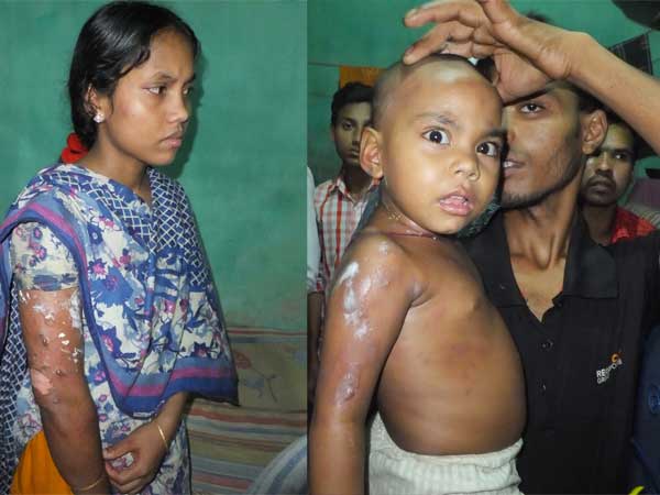 গরম তেলে ঝলসে গেল মা-মেয়ে.....