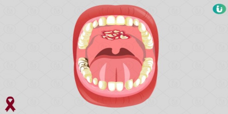 মুখের ক্যান্সার ঝুঁকি কমাবেন যেভাবে ।।